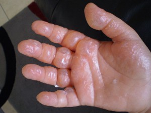 800px-Phytophotodermatitis-Severe-Case-300x225