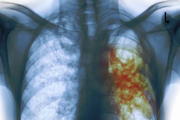 tuberculosis