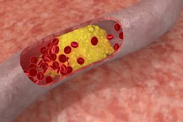 paraziták az emberi testben mellékhatások condyloma acuminata lsil