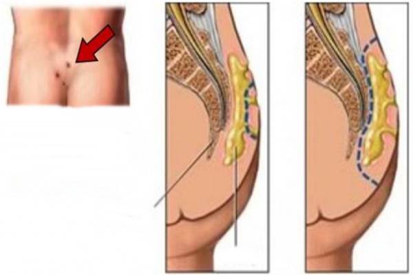 fenék feletti fájdalom a csípőízület deformáló ízületi gyulladása okozza