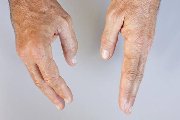 Ízületi gyulladás (artritisz) - Leírás és gyógykezelés