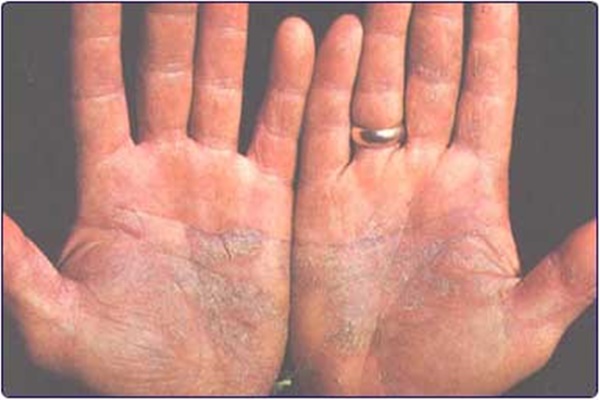 A vitiligo testi-lelki okai