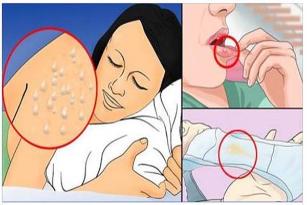 Hiv fogyás tünetei, Hasmenés, köhögés, fekélyek: a HIV-fertőzés tünetei