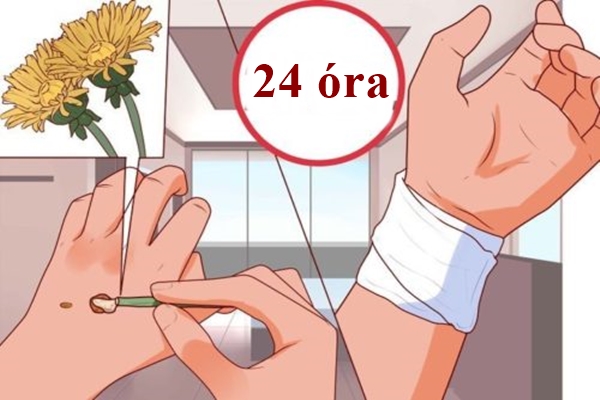 Így szüntesd meg a zavaró szemölcsöt 1 éjszaka alatt!
