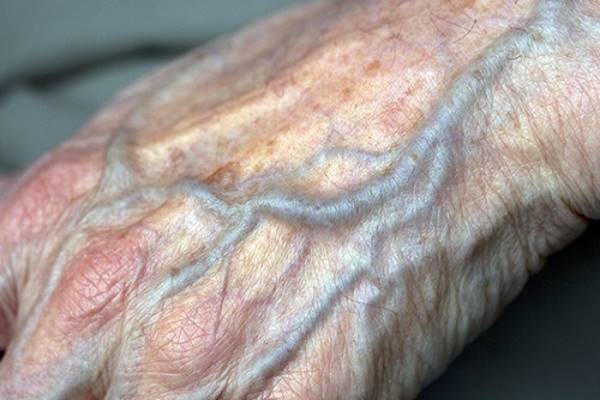 Image result for poor circulation in hands veins