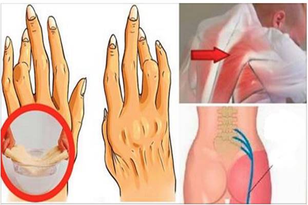 ízületi fájdalom azonnal az artrózis három szakaszának kezelése