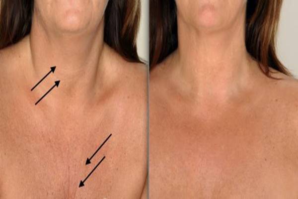 Idősödő nyak, dekoltázs kezelése - Dr. Csernus Krisztina Bőrgyógyász