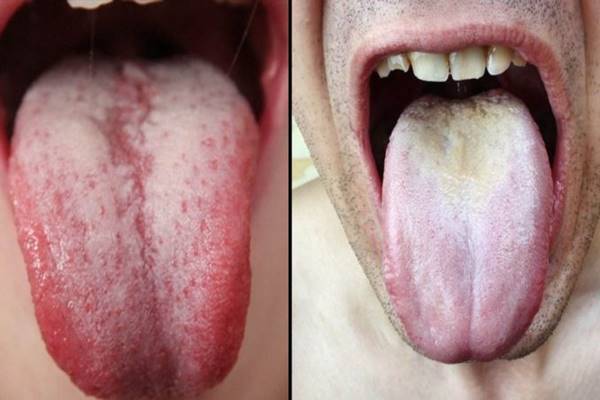 a rossz lehelet okozza a nyelv lepedékét hogyan lehet eltávolítani a férgek petéit